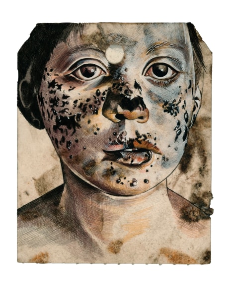 Stotik - boy black skin spots