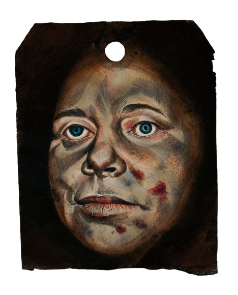 Stotik - bruised face