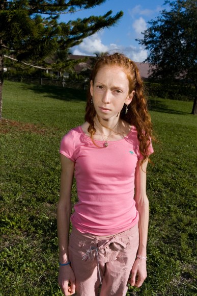 Aiva, 16, First Day of Treatment, Coconut Creek Florida, 2005, Archival Pigment Print