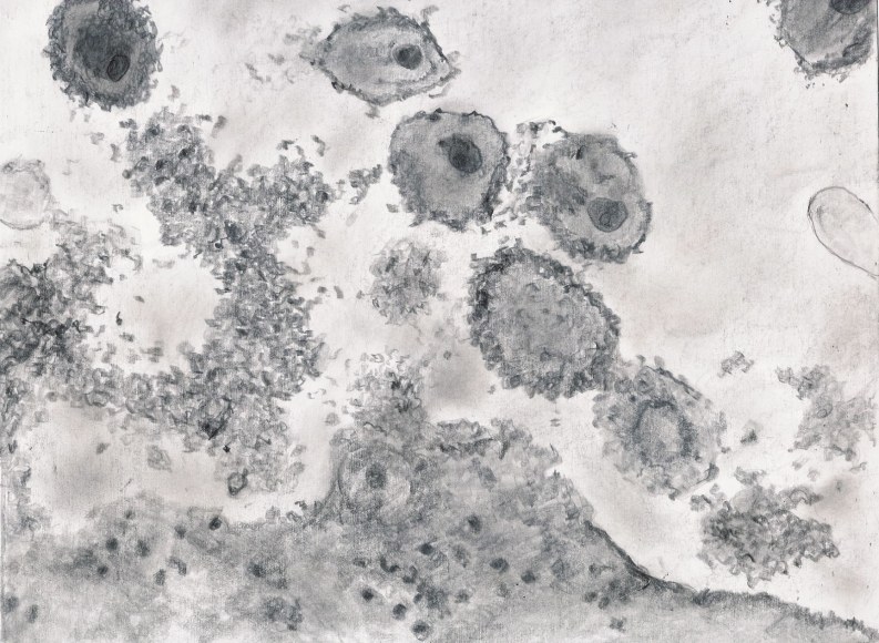 Jody Rasch, Deficiency 6 - HIV