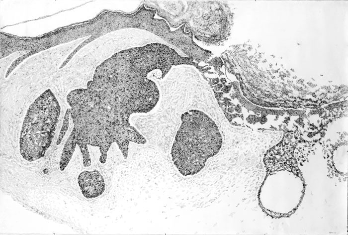 Jody Rasch, Beauty - Basal Cell