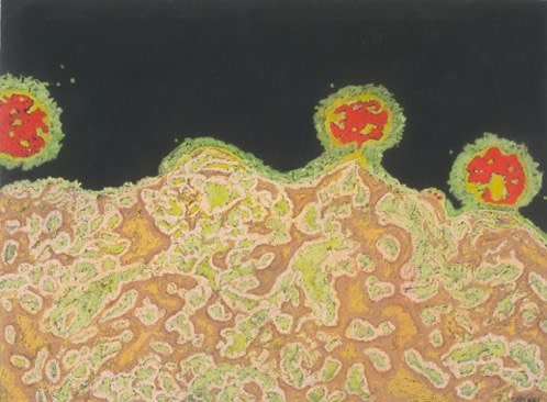 Jody Rasch, Deficiency 2 - HIV