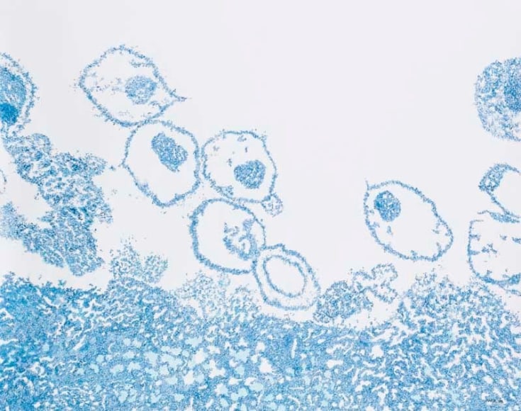 Jody Rasch, Deficiency Blue - HIV