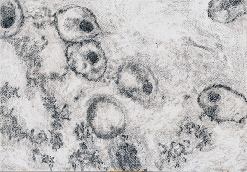 Jody Rasch, Deficiency 5 - HIV