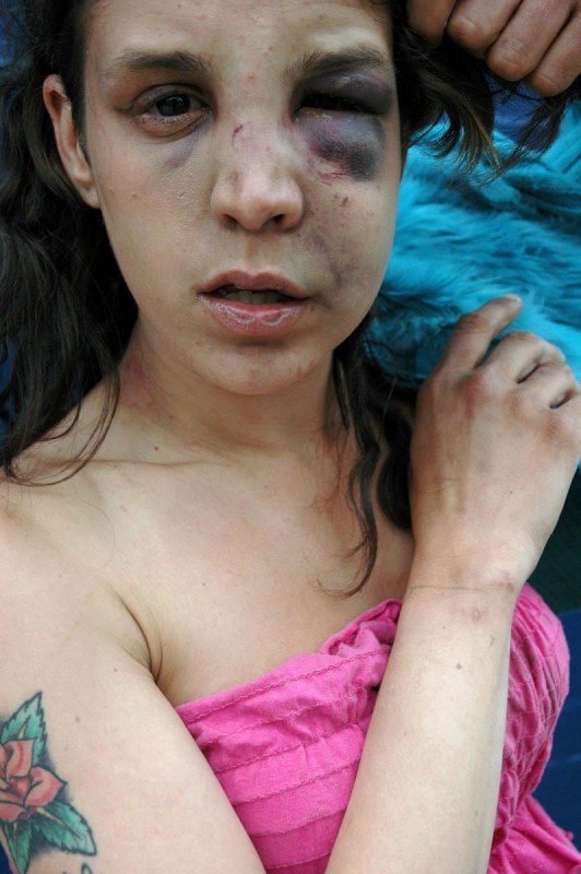 Zoe Strauss -
Monique Showing Black Eye, 2001-2006 | Bruce Silverstein Gallery