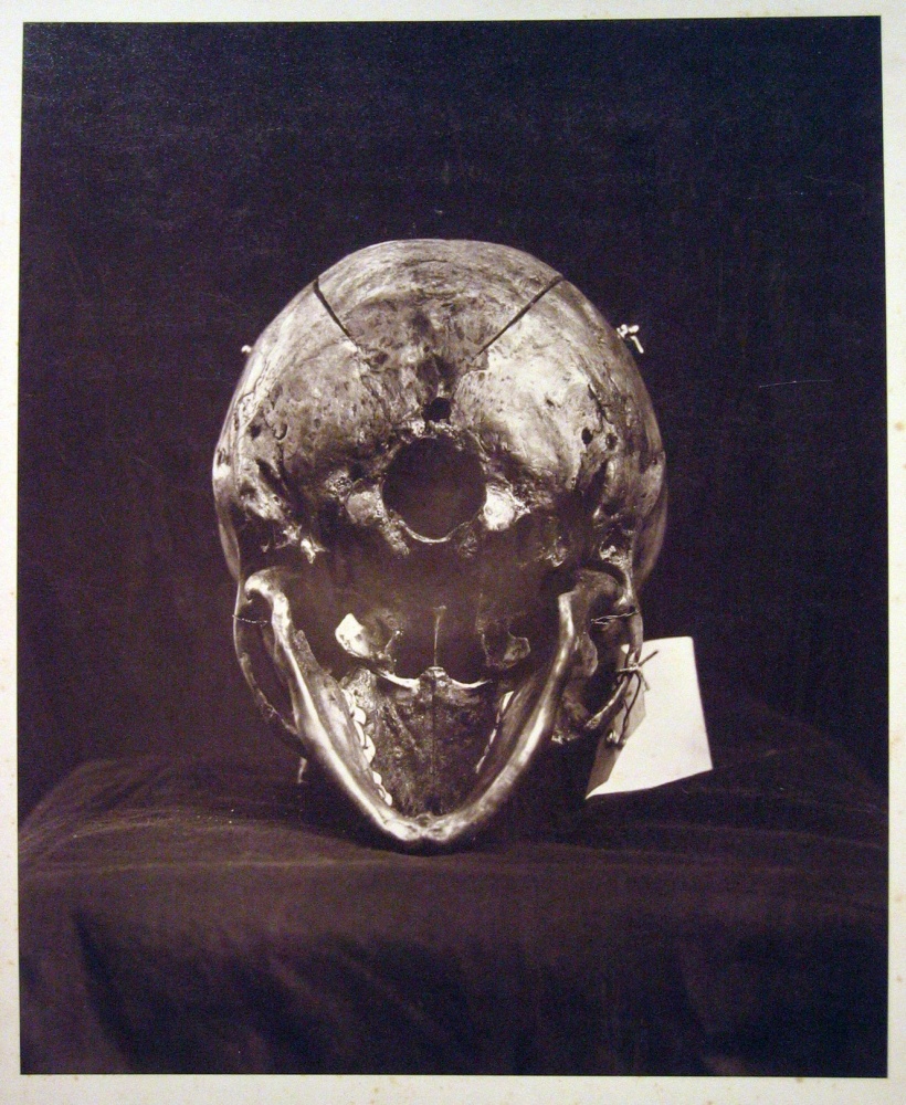 BELGIAN JUDICIARY SERVICE The Peltzer Case, skull of M. Bernays as evidence, circa 1882 Carbon print 31.7 x 25.9 cm