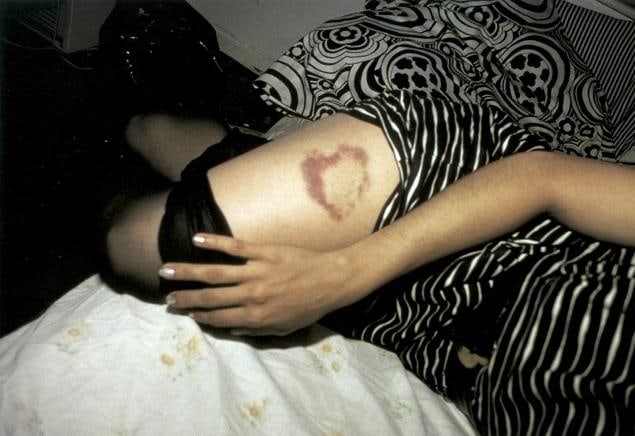 Image of NAN GOLDIN's Heart-shaped Bruise, NYC, 1980