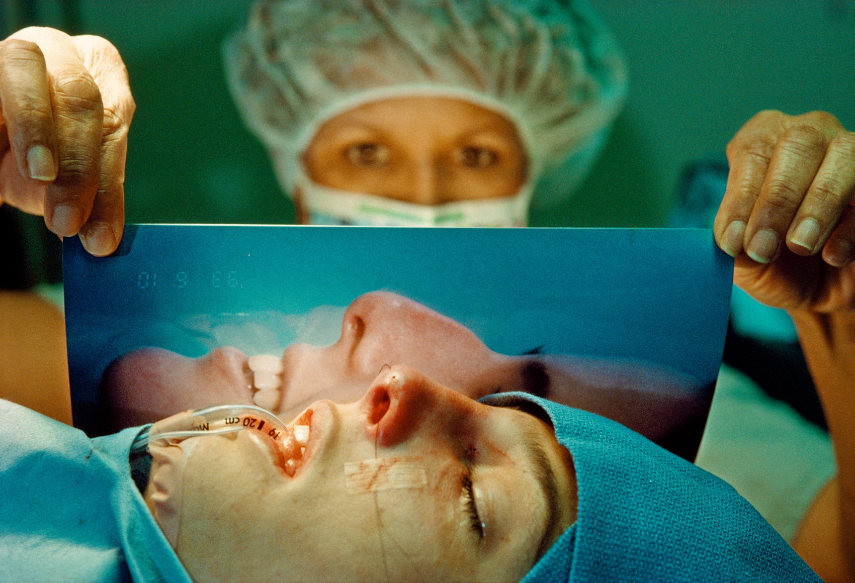 Lindsey, 18, after Her Nose-Job Surgery, West Hollywood, 1993, Archival Pigment Print