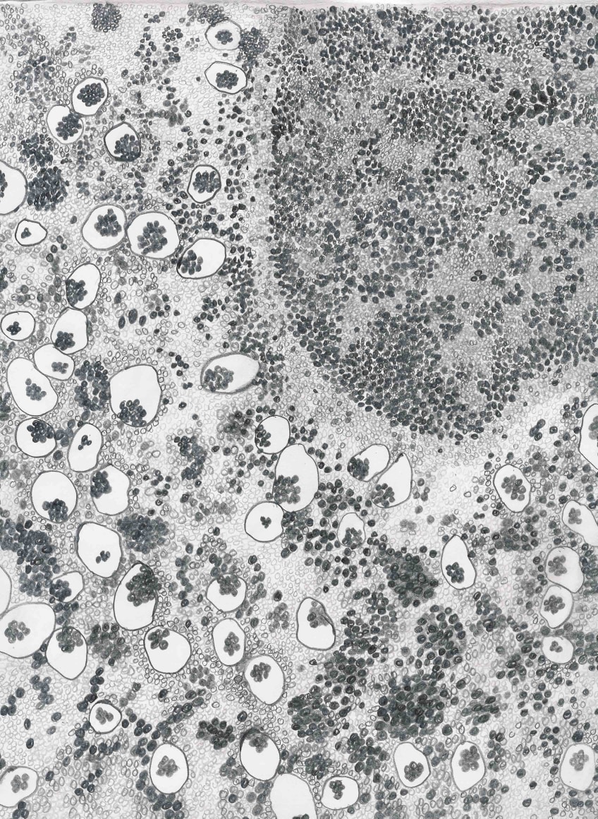 Jody Rasch, Sweet - Diabetes