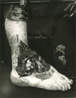 Frederick Sommer - Untitled (Amputated Foot), 1939 Gelatin silver print mounted to board, printed c. 1980s | Bruce Silverstein Gallery