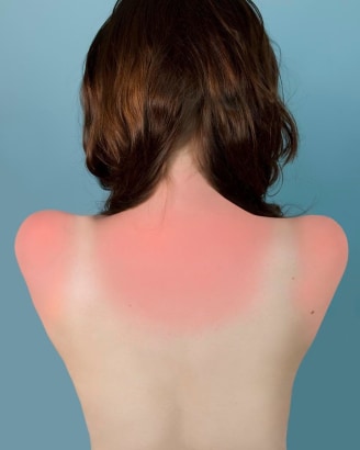 Brea Souders - Sunburn in Naples, 2010 Archival inkjet print | Bruce Silverstein Gallery
