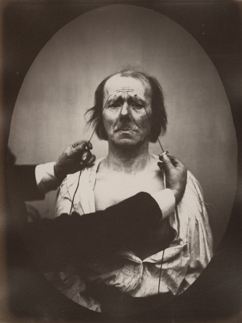 DUCHENNE DE BOULOGNE and Adrien TOURNACHON (French, 1806-1875 &amp; 1825-1903) Profound suffering, with resignation, , 1862, negative, circa 1856 Albumen print from a glass negative 22.4 x 16.6 cm oval on 22.7 x 17.2 cm paper, mounted on 41.0 x 27.5 cm paper &quot;20&quot; in pencil on mount. &quot;Fig 20&quot; in pencil on mount verso.