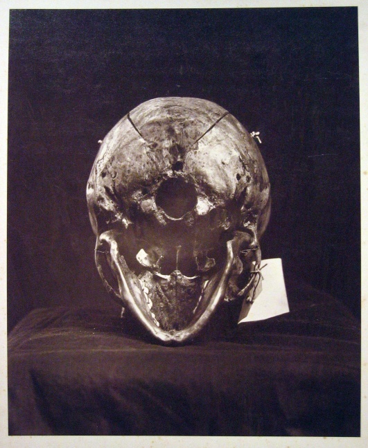 BELGIAN JUDICIARY SERVICE The Peltzer Case, skull of M. Bernays as evidence, circa 1882 Carbon print 31.7 x 25.9 cm
