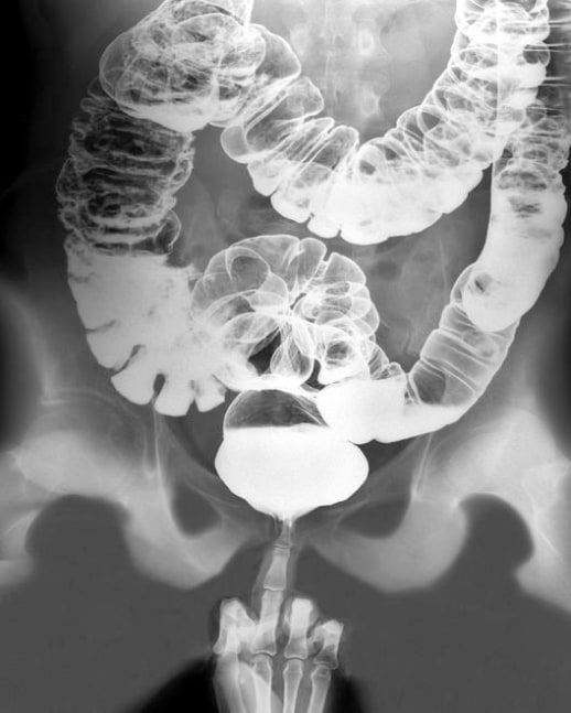 x-ray of a pelvis and intestines with a middle finger inserted into the rear