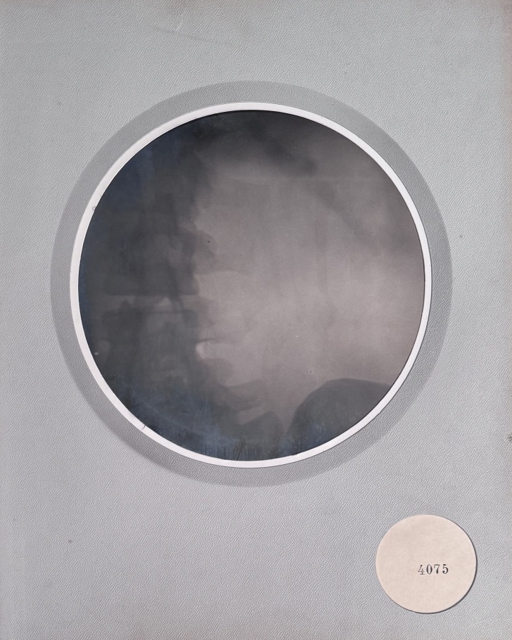 CHARLES INFROIT (1874-1920) SPINAL X-RAYS 1910